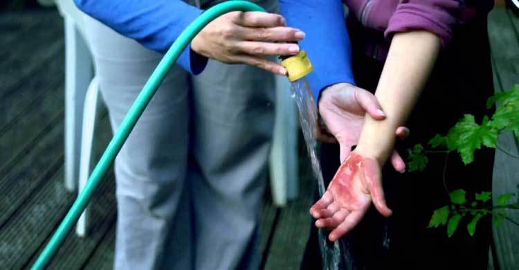 পোড়া ত্বকের ঘরোয়া চিকিৎসা