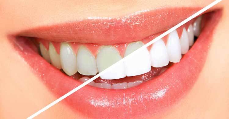 Whiten your teeth in just 3 minutes