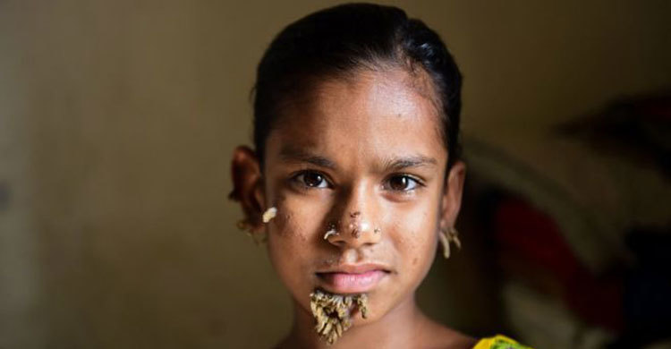 বিশ্বের প্রথম বৃক্ষমানবী বাংলাদেশের শাহানা!