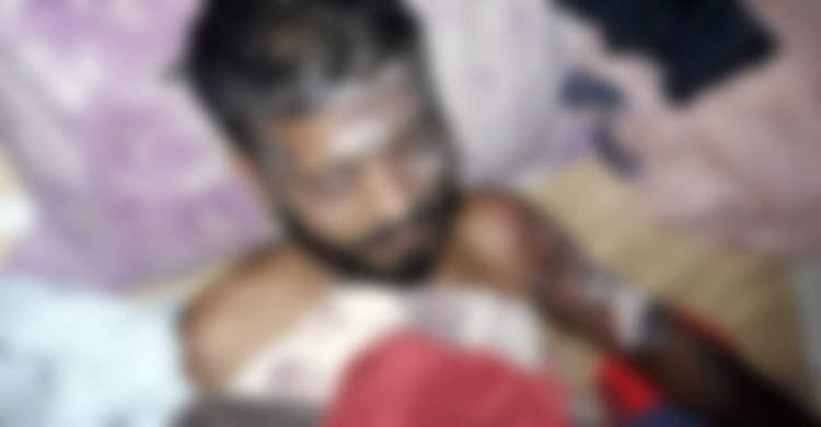 সন্ত্রাসীর ঢেলে দেয়া গরম তেলে ঝলসে গেছে ইমরান