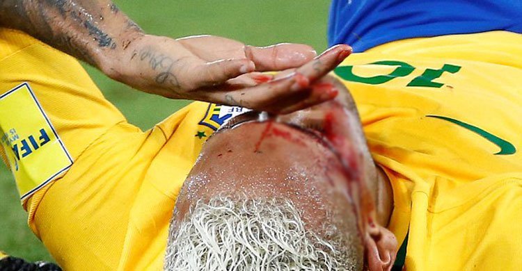 Neymar’s face covered in blood 