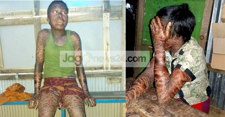 শাহাদাতের চিকিৎসা করাতে গিয়ে পরিবার নিঃস্ব