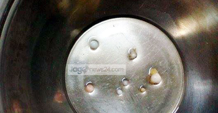 রোগীর এক চোখ থেকেই বের হলো ৮টি পাথর!