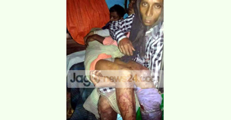 নাইক্ষ্যংছড়িতে মাইন বিস্ফোরণে কিশোর আহত