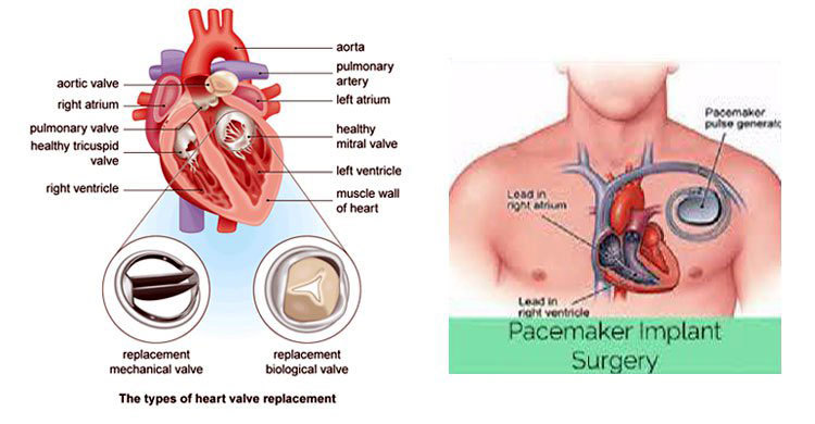 হার্ট ভাল্ব পেসমেকারের মূল্য চূড়ান্ত : আনুষ্ঠানিক ঘোষণা কাল
