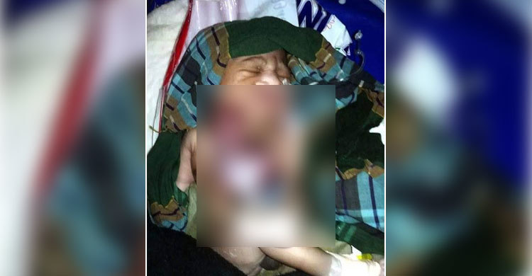 শরীরের বাইরে হৃদপিন্ড ও খাদ্যনালী নিয়ে বিরল শিশুর জন্ম