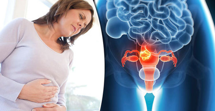 Uterus cancer kills 11,000 women annually in Bangladesh