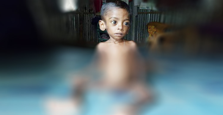 অভাবে ছেলের চিকিৎসা করাতে পারছেন না বাবা