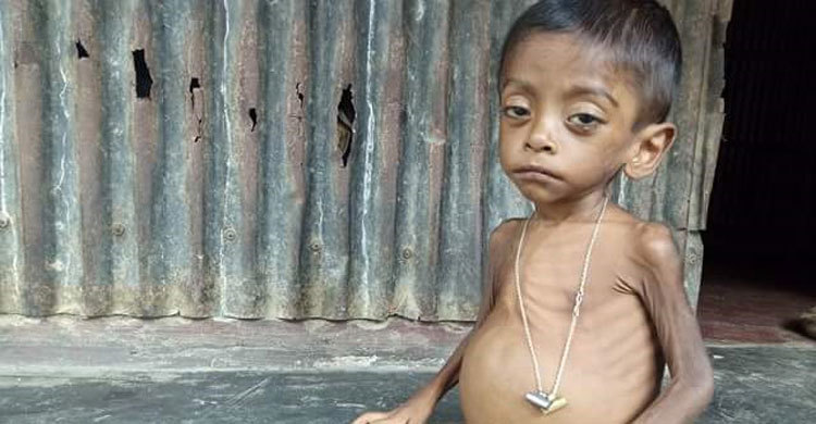 বায়েজিদের চিকিৎসা হচ্ছে শিশু হাসপাতালে