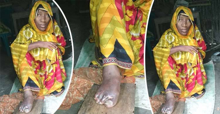 পায়ে পচন ধরেছে বিধবা আবিরন বিবির