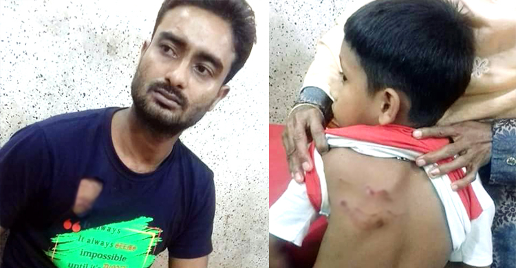 কুমিল্লায় কুকুরের কামড়ে শিশুসহ আহত ২৪