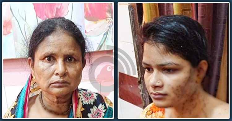 ব্রাহ্মণবাড়িয়ায় স্ত্রী-শাশুড়ির শরীরে জামাইয়ের অ্যাসিড নিক্ষেপ