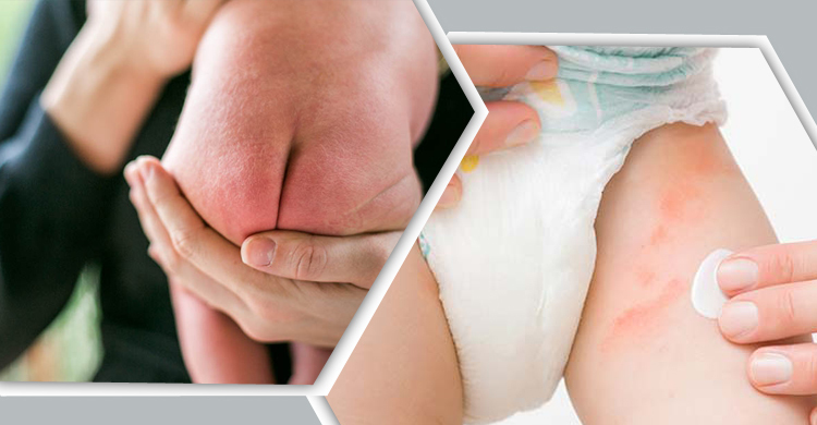 গরমে শিশুর ‘ডায়াপার র‌্যাশ’ সারানোর ঘরোয়া উপায়