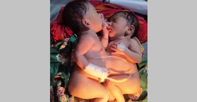 বরিশালে জোড়া লাগানো শিশুর জন্ম, ঢাকায় নেয়ার টাকা নেই পরিবারের