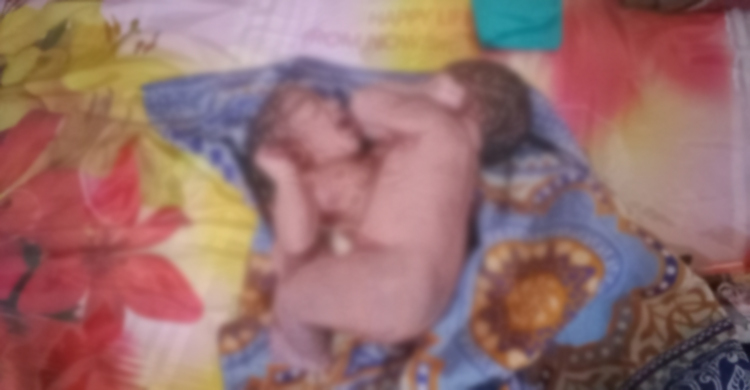 ভোলায় জন্ম নিলো পেট জোড়া লাগা জমজ শিশু