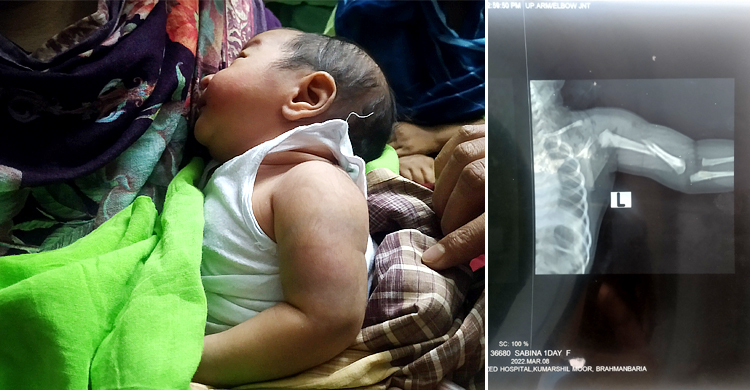 সিজারের সময় নবজাতকের হাত ভাঙার ঘটনা তদন্তে কমিটি