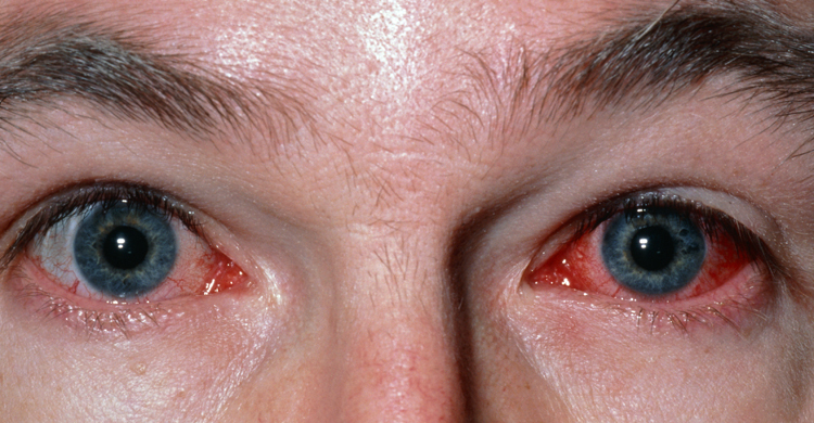 কনজাঙ্কটিভাইটিস কি করোনার লক্ষণ?