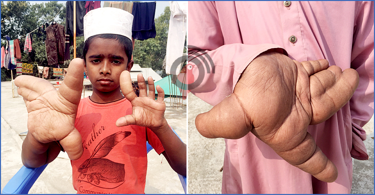 অতিরিক্ত ওজনের হাত নিয়ে বিপাকে ৭ বছরের রোহান