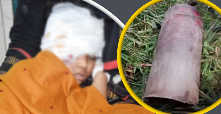 সিলিন্ডার বিস্ফোরণ: আহতদের শরীরে হাজারো লোহার ক্ষুদ্র কণা
