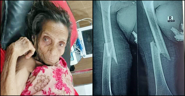 ফের নিজ পায়ে দাঁড়াতে পারবেন ৯০ বছরের বৃদ্ধা মাকচাঁন