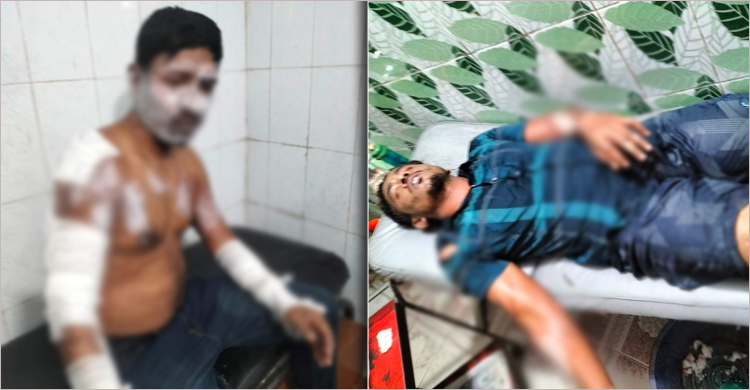 দিয়াশলাইয়ের কাঠি ঠুকতেই পুরো ঘরে আগুন, দগ্ধ ৪