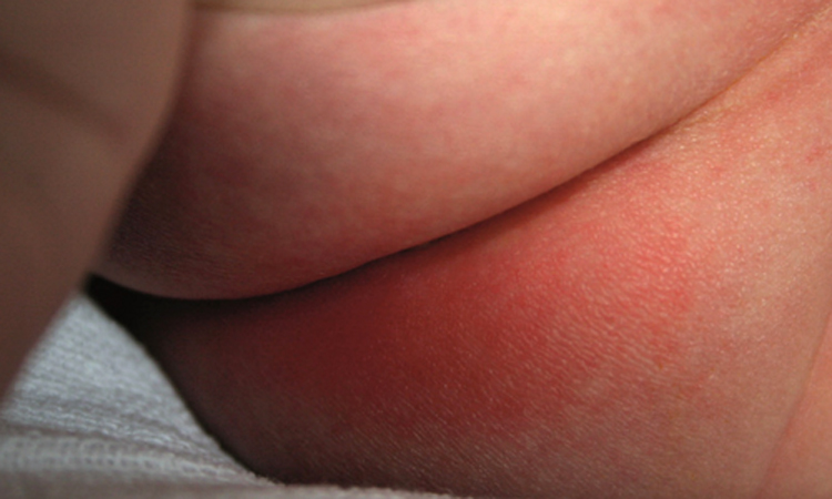 গরমে শিশুর ‘ডায়াপার র্যাশ’ সারানোর ঘরোয়া উপায়