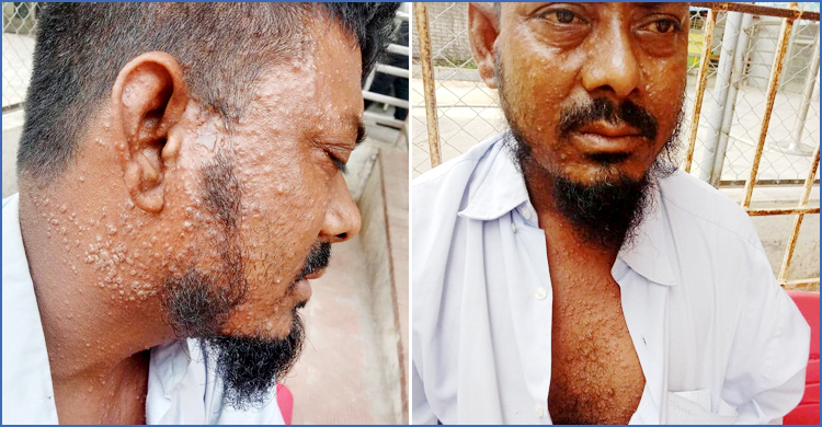 মাঙ্কিপক্স সন্দেহে ভারতফেরত যাত্রীকে যশোর হাসপাতালে ভর্তি