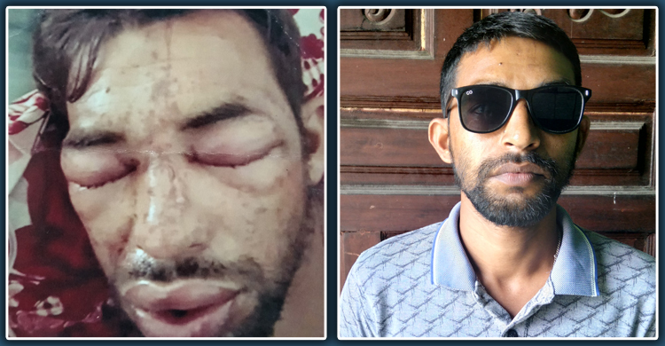 কোনো সহযোগিতা পাননি ঝলসে যাওয়া আজিম