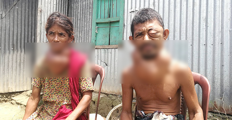 দেশেই চিকিৎসা সম্ভব গলগণ্ড আক্রান্ত দুই ভাই-বোনের, সমস্যা টাকা