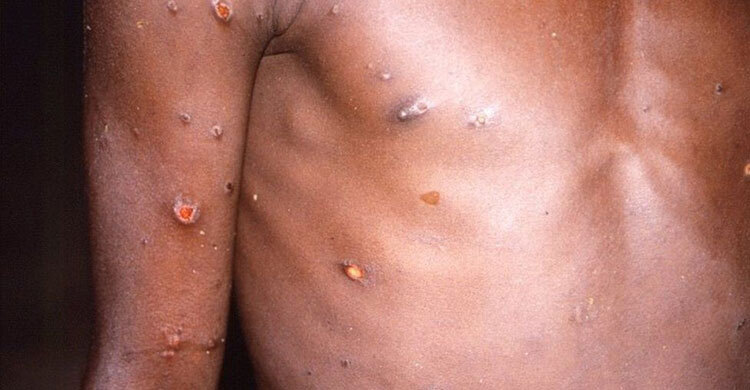 Monkeypox: 80 cases confirmed in 11 countries, says WHO