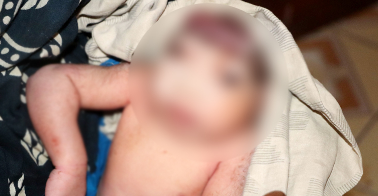 নাটোরে খুলি-মস্তকবিহীন শিশুর জন্ম