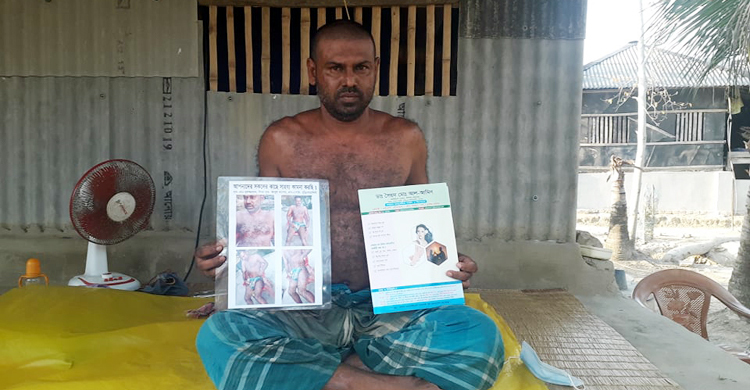অজানা চর্মরোগে আক্রান্ত দরিদ্র নুরুজ্জামান