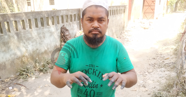 দু’হাতের আট আঙুল ‘পাথর’ হয়ে গেছে নুরুল আমিনের