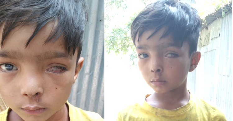 অর্থাভাবে দুটি চোখই নষ্ট হওয়ার পথে শিশু রিফাতের
