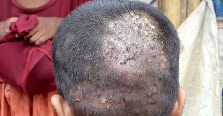 রোহিঙ্গা ক্যাম্পে ছোঁয়াচে চর্মরোগের প্রাদুর্ভাব