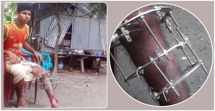 টাকার অভাবে ভাঙা পা থেকে রড বের করতে পারছেন না ইউসুফ