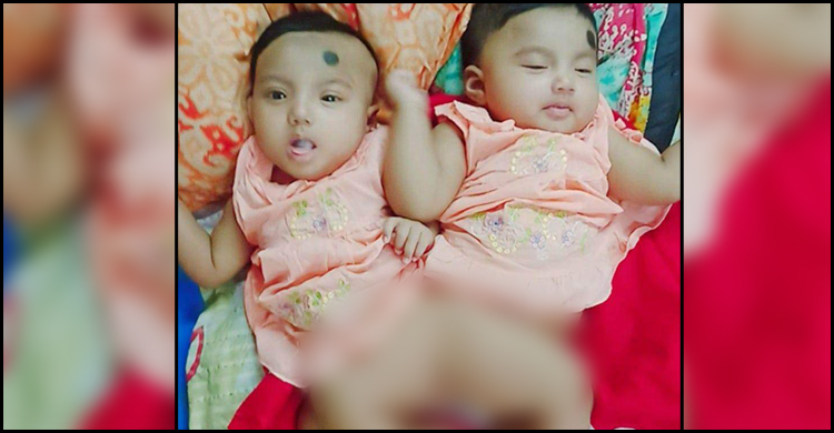 দেশে প্রথম জোড়া মেরুদণ্ডের দুই শিশুকে আলাদা করবে বিএসএমএমইউ