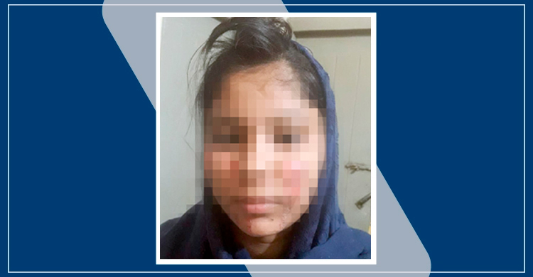 যৌতুক না দেয়ায় স্ত্রীর চুল-ভ্রু কেটে মুখ পুড়িয়ে দিলেন স্বামী