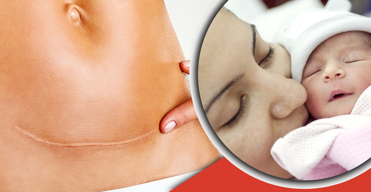 সিজারের দাগ দূর করার ঘরোয়া উপায়