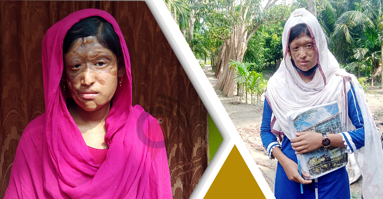 অ্যাসিডে ঝলসে যায়নি সোনালির স্বপ্ন