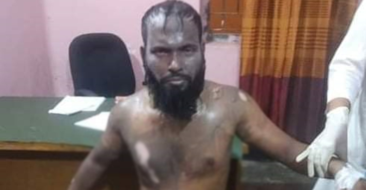 তিন বিয়ে করায় ব্যাংক কর্মকর্তা স্বামীকে অ্যাসিডে ঝলসে দিলো স্ত্রী