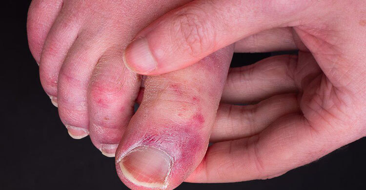 Study reveals why some people get Covid toe condition