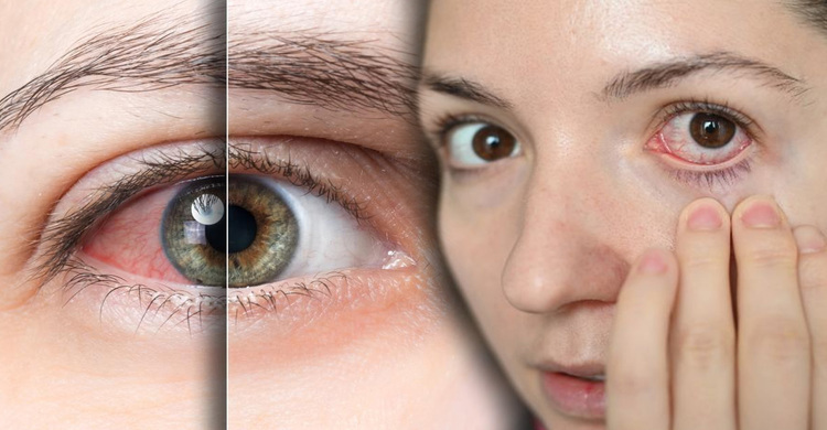 ড্রাই আই ও চোখ লাল হলে করণীয়