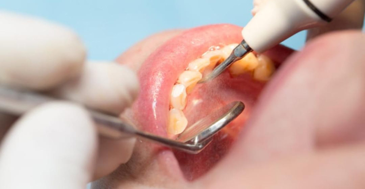 আক্কেল দাঁত: মুখের ছোট অতিথি, বড় ঝামেলা