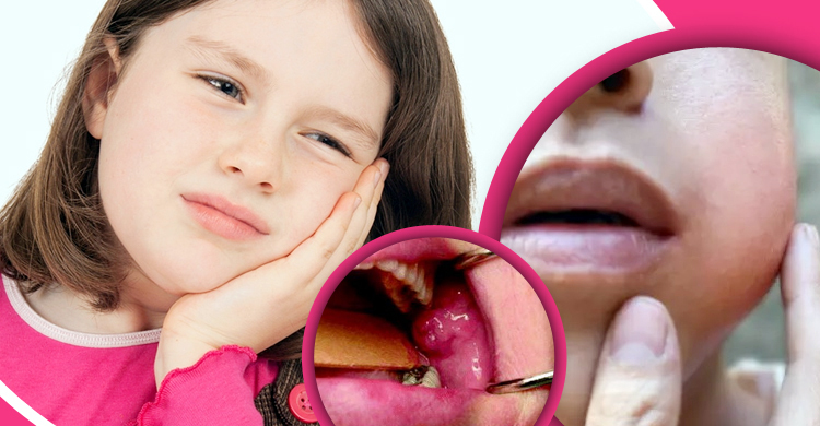 মাম্পস কী? কাদের হয় ও এর লক্ষণ কী?