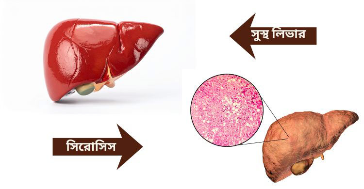 নীরবে অনেক দূর এগিয়ে যেতে পারে লিভার সিরোসিস