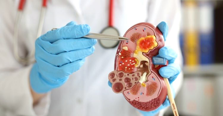 কিডনি রোগের ঝুঁকিতে আছেন যারা, জানুন বিশেষজ্ঞের পরামর্শ