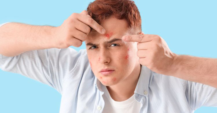 টিনএজ শেষ হয়েছে সেই কবে, তবু মুখে ব্রণ! কারণ জানুন