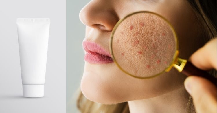 ত্বকে ব্রণের দাগ থাকলে ক্লিনজারে যেসব উপাদান খুঁজবেন
