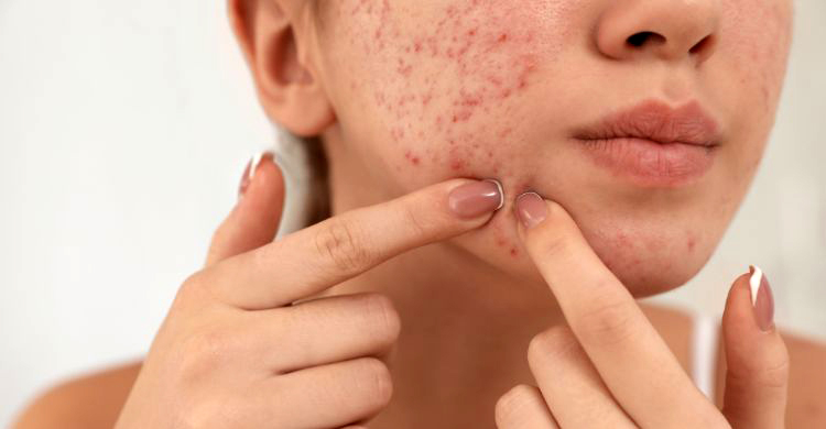টিনএজ শেষ হয়েছে সেই কবে, তবু মুখে ব্রণ! কারণ জানুন